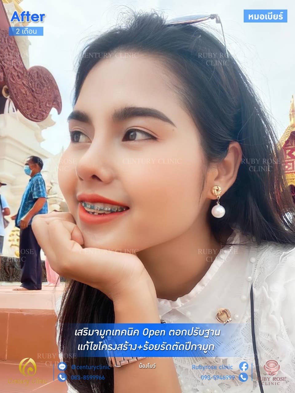 รีวิว แก้จมูกเทคนิค Open ตอกปรับฐาน 2#46