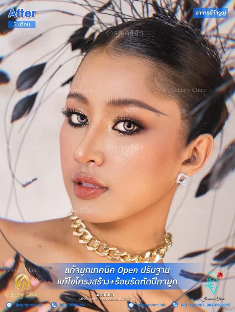 รีวิว แก้จมูกเทคนิค Open ตอกปรับฐาน #42
