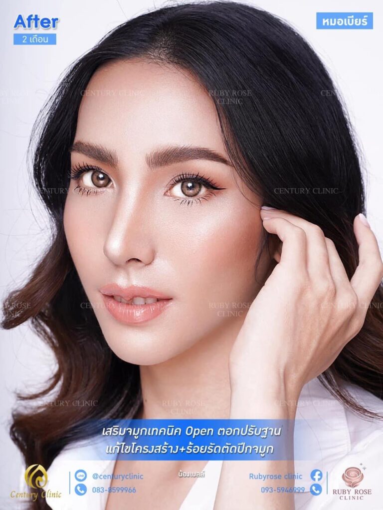 รีวิว แก้จมูกเทคนิค Open ตอกปรับฐาน #44