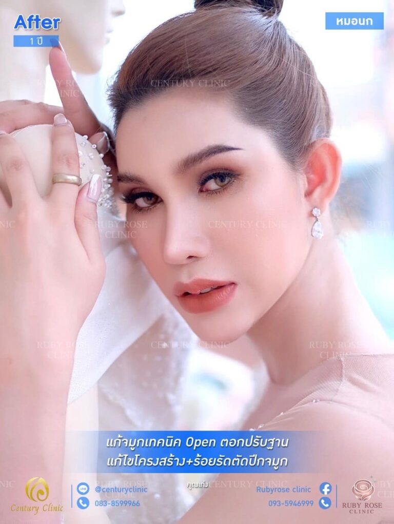 รีวิว แก้จมูกเทคนิค Open ตอกปรับฐาน #45