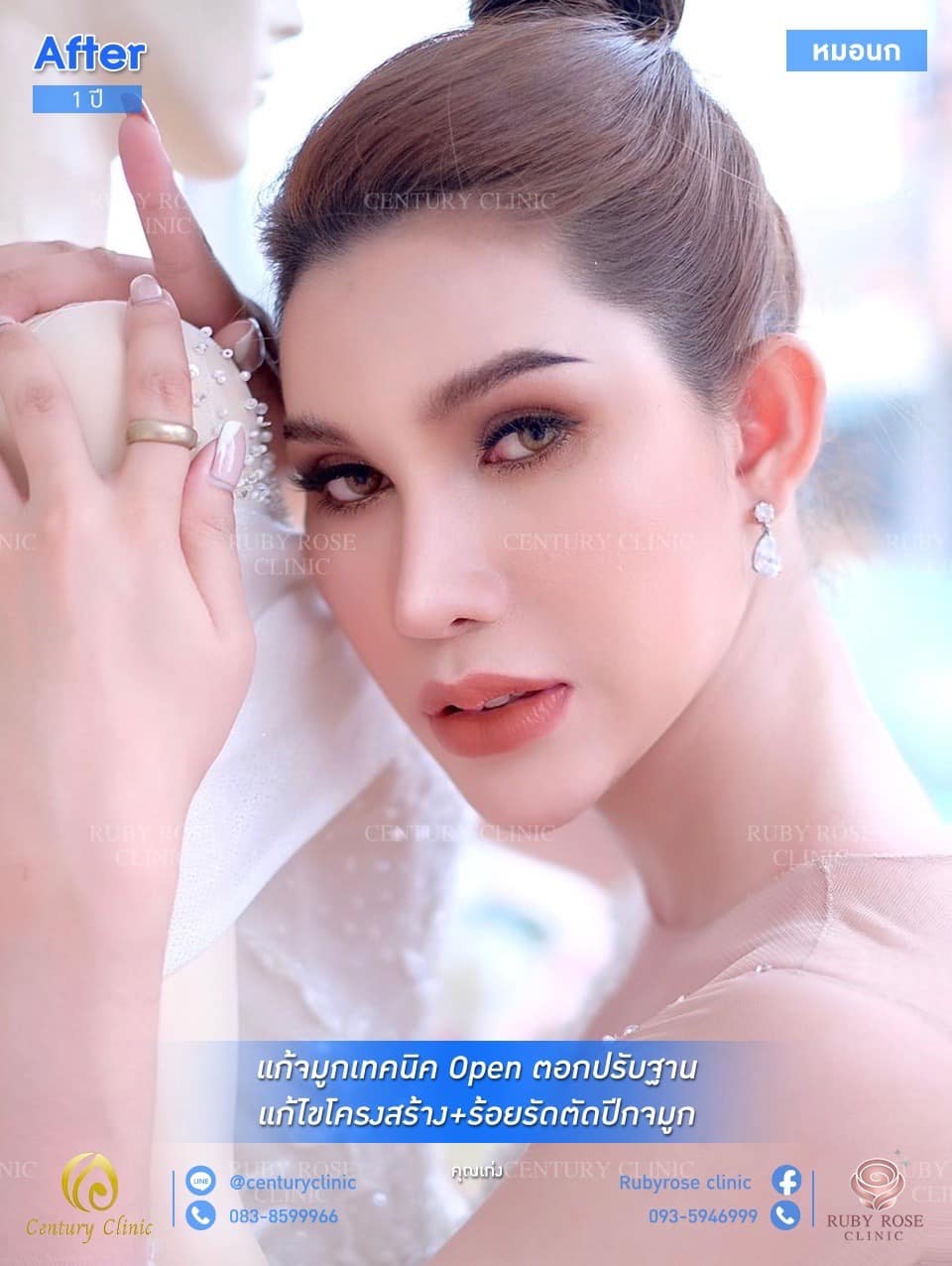 รีวิว แก้จมูกเทคนิค Open ตอกปรับฐาน #45