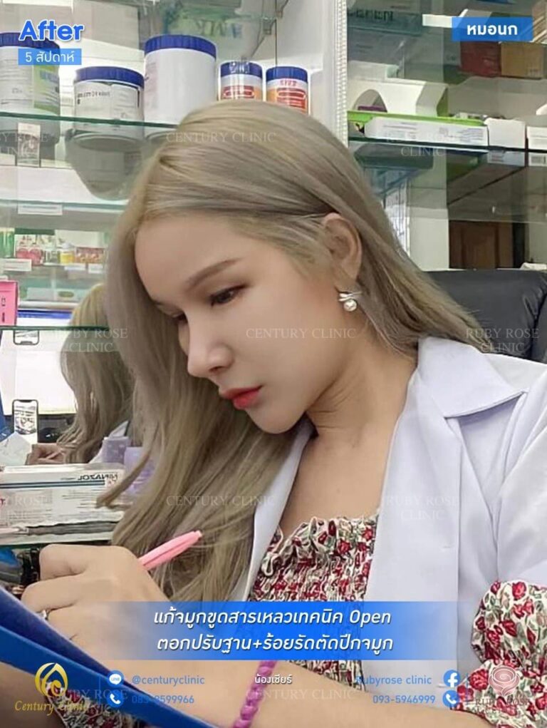 รีวิว แก้จมูกเทคนิค Open ตอกปรับฐาน #47