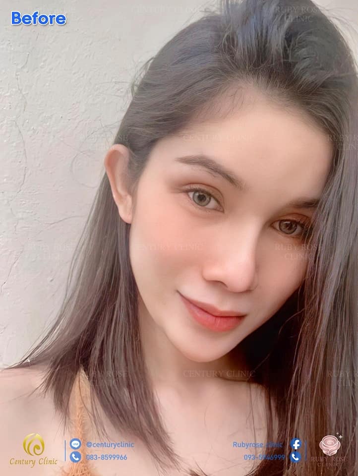 รีวิว แก้จมูกเทคนิค Open ตอกปรับฐาน1 #45