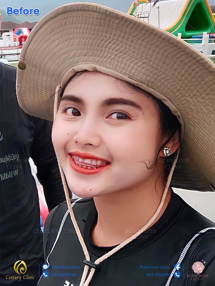 รีวิว แก้จมูกเทคนิค Open ตอกปรับฐาน1 #46