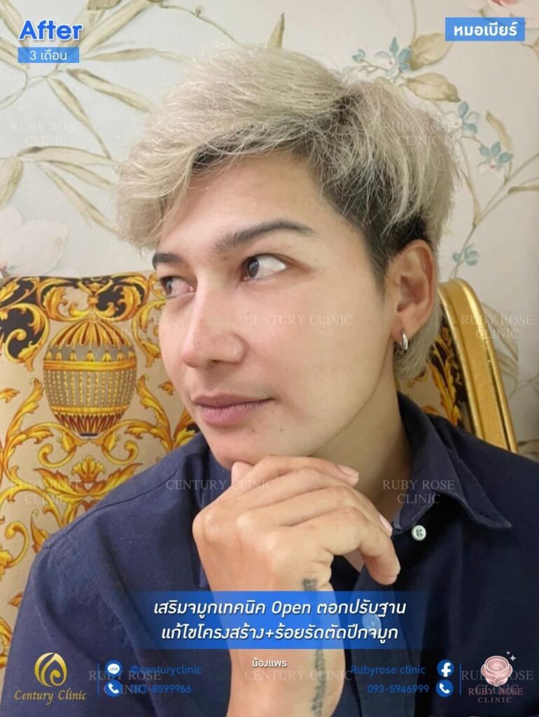 Century รีวิว เสริมจมูก 1#174