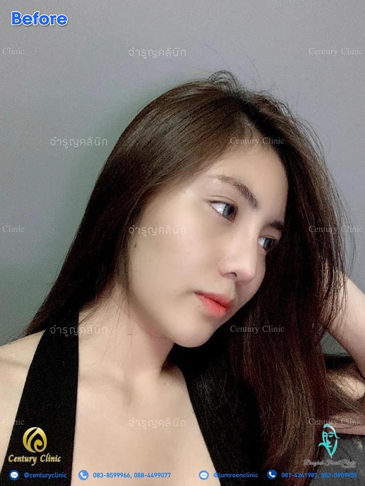 Century รีวิว เสริมจมูก 1#176