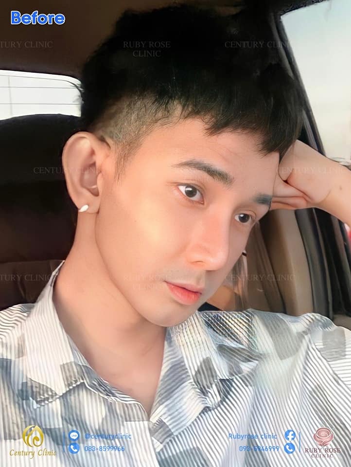 Century รีวิว เสริมจมูก 1#177