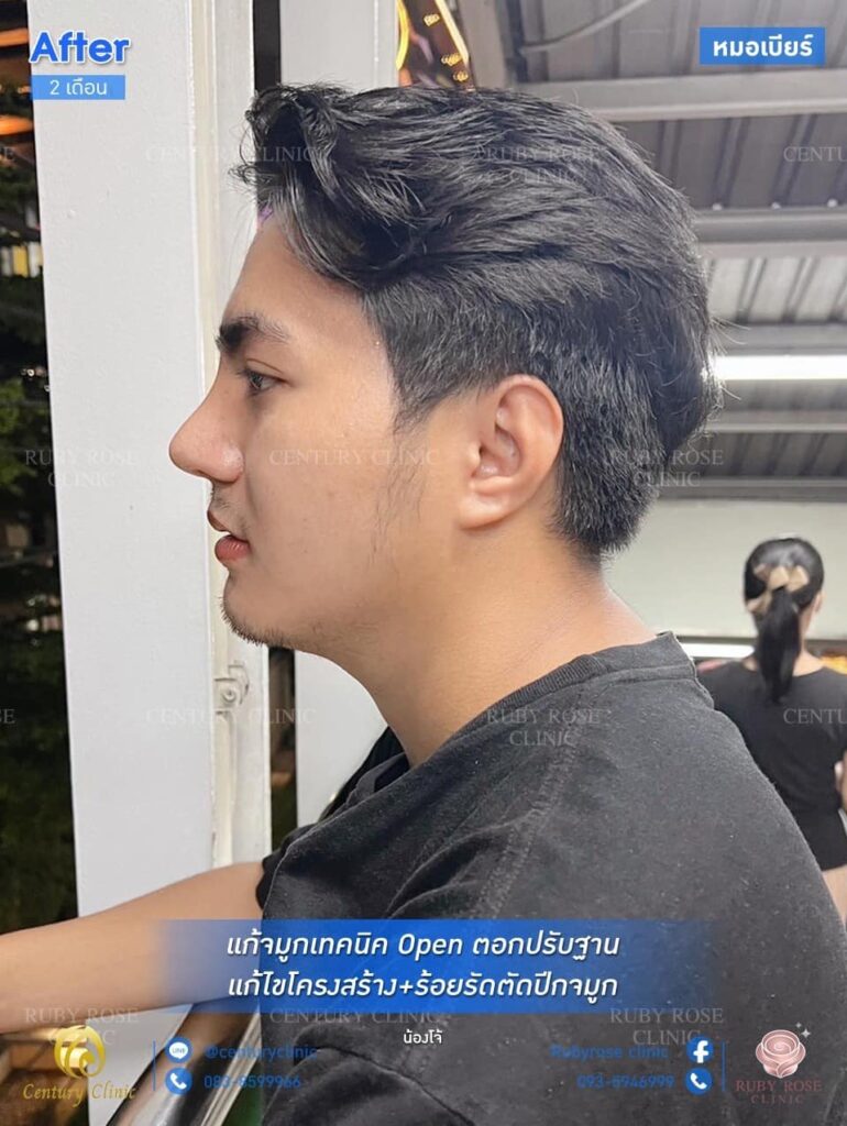 รีวิว แก้จมูก #178 , Century Clinic Thailand Century รีวิว เสริมจมูก 1#178