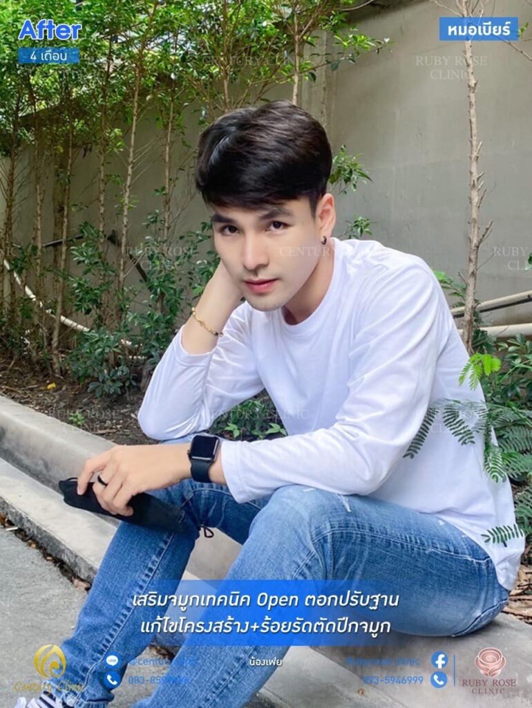 Century รีวิว เสริมจมูก 1#193