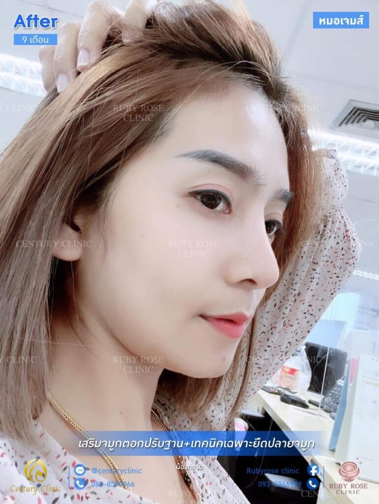รีวิว เสริมจมูก #203 , Century Clinic Thailand Century รีวิว เสริมจมูก 1#203