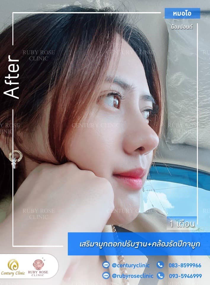 รีวิว เสริมจมูก #210 , Century Clinic Thailand Century รีวิว เสริมจมูก 1#210