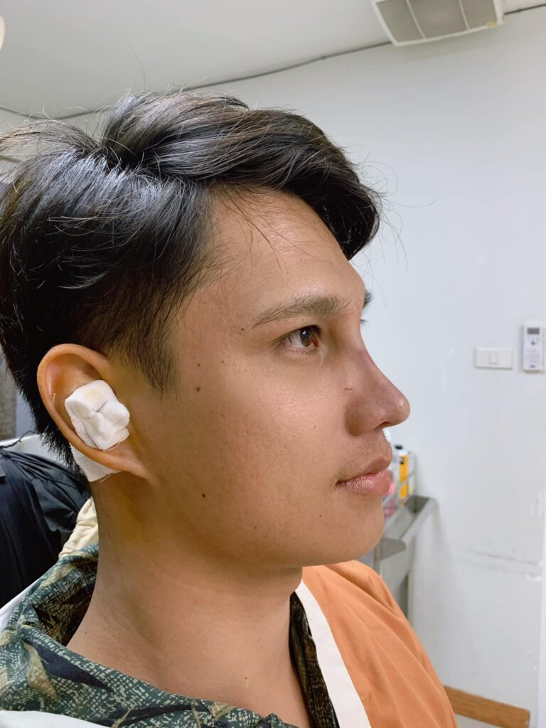 รีวิว เสริมจมูก #220 , Century Clinic Thailand Century รีวิว เสริมจมูก 1#220