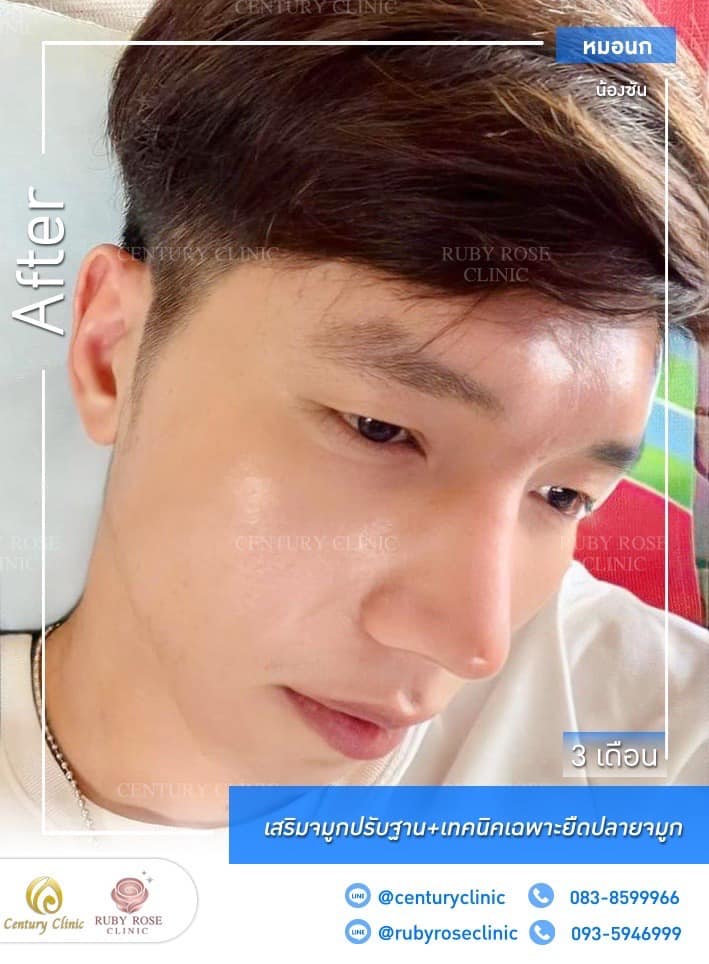 Century รีวิว เสริมจมูก 1#229