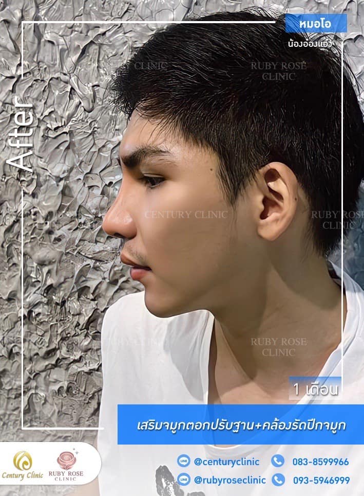 Century รีวิว เสริมจมูก 1#240