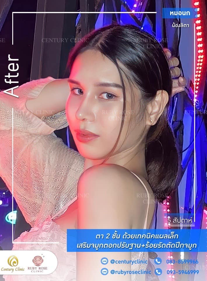 รีวิว เสริมจมูก #256 , Century Clinic Thailand Century รีวิว เสริมจมูก 1#256