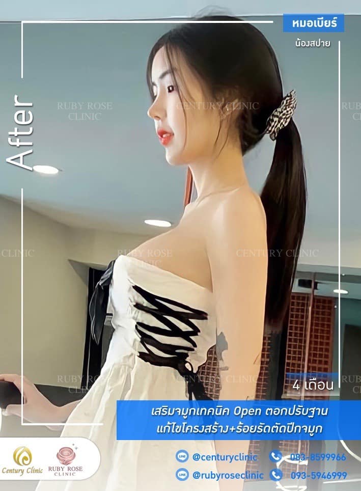 Century รีวิว เสริมจมูก 1#257