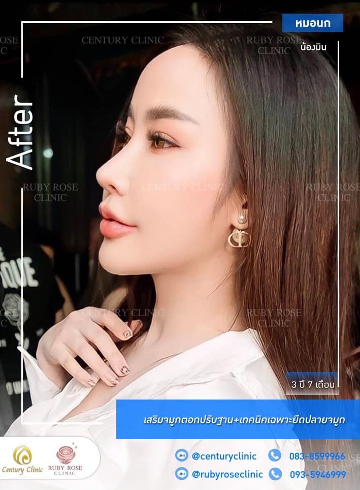 รีวิว เสริมจมูก #258 , Century Clinic Thailand Century รีวิว เสริมจมูก 1#258