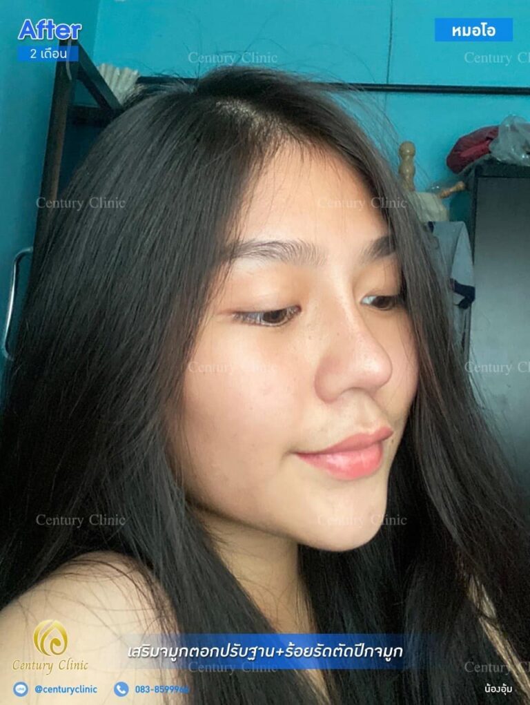 Century รีวิว เสริมจมูก #157