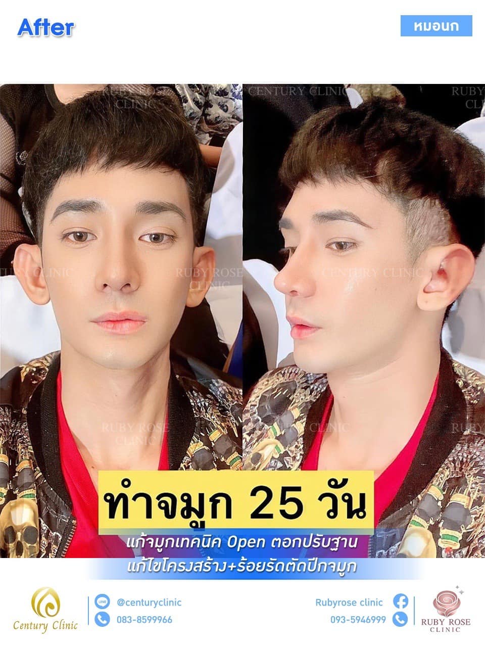 Century รีวิว เสริมจมูก #177