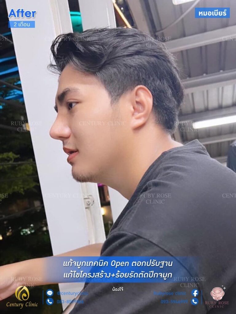Century รีวิว เสริมจมูก #178