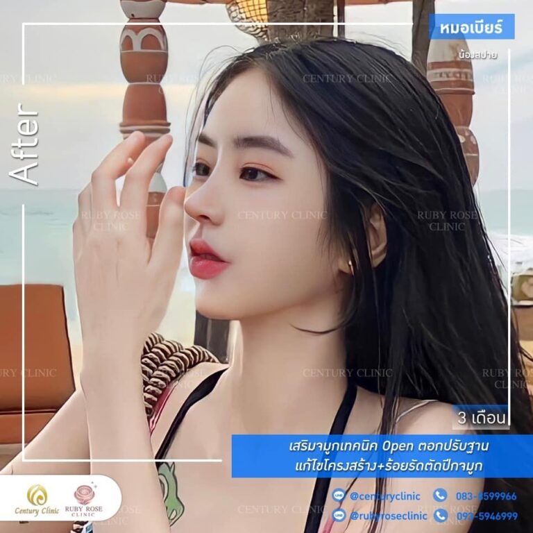 Century รีวิว เสริมจมูก #187