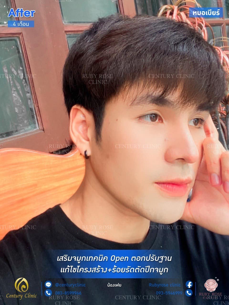 Century รีวิว เสริมจมูก #193