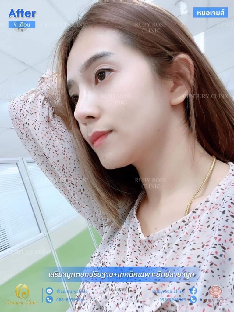 Century รีวิว เสริมจมูก #203