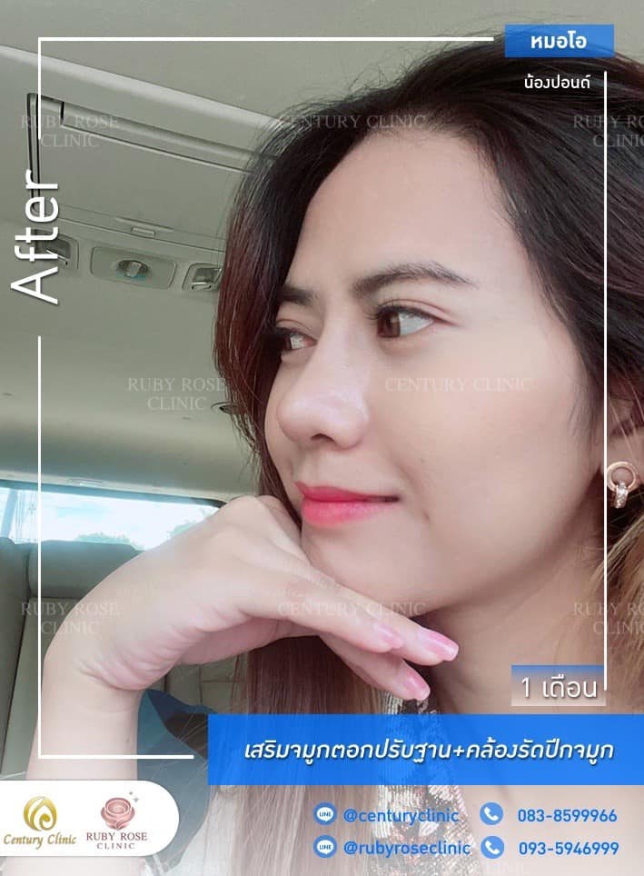 Century รีวิว เสริมจมูก #210