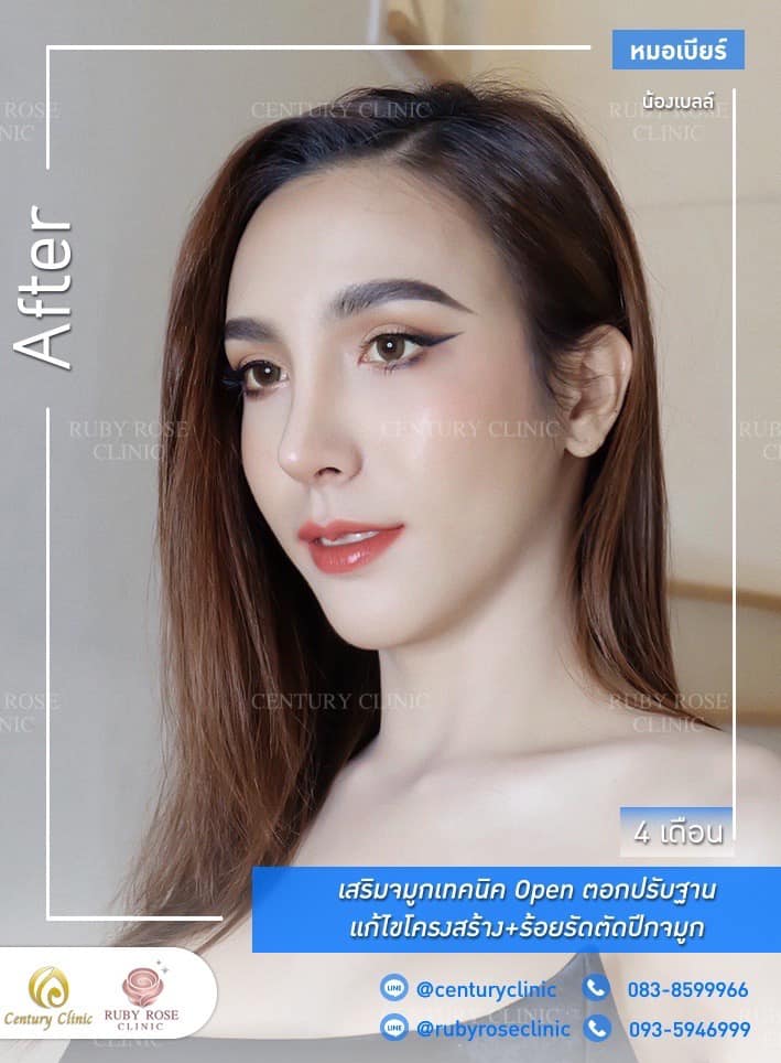 Century รีวิว เสริมจมูก #219