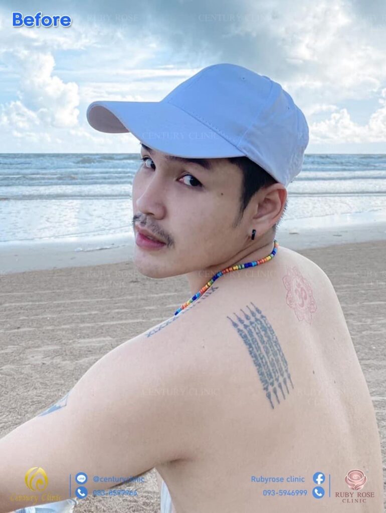 Century รีวิว เสริมจมูก 2#193