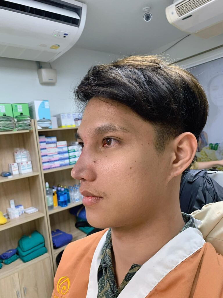 Century รีวิว เสริมจมูก #220