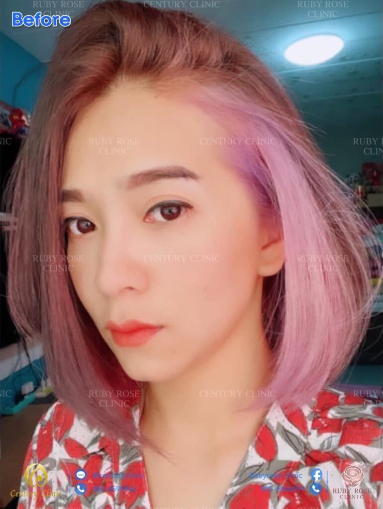 รีวิว เสริมจมูก #203 , Century Clinic Thailand Century รีวิว เสริมจมูก 2#203