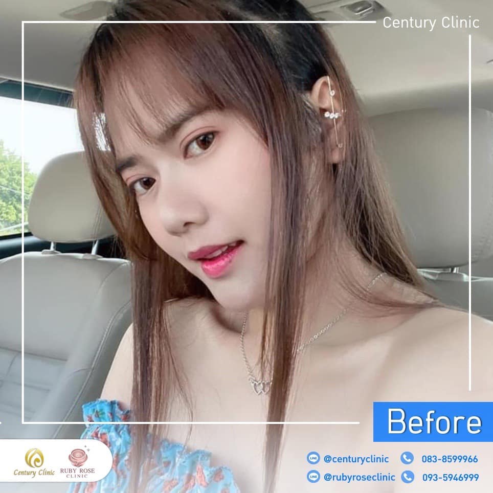 รีวิว เสริมจมูก #210 , Century Clinic Thailand Century รีวิว เสริมจมูก 2#210