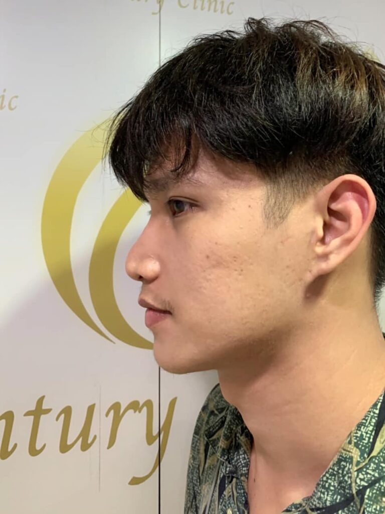 รีวิว เสริมจมูก #220 , Century Clinic Thailand Century รีวิว เสริมจมูก 2#220