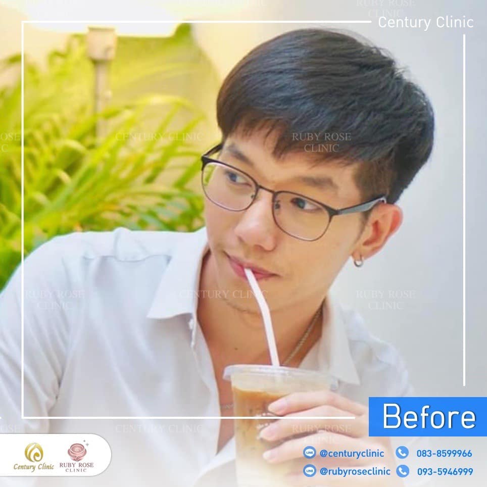 Century รีวิว เสริมจมูก 2#229