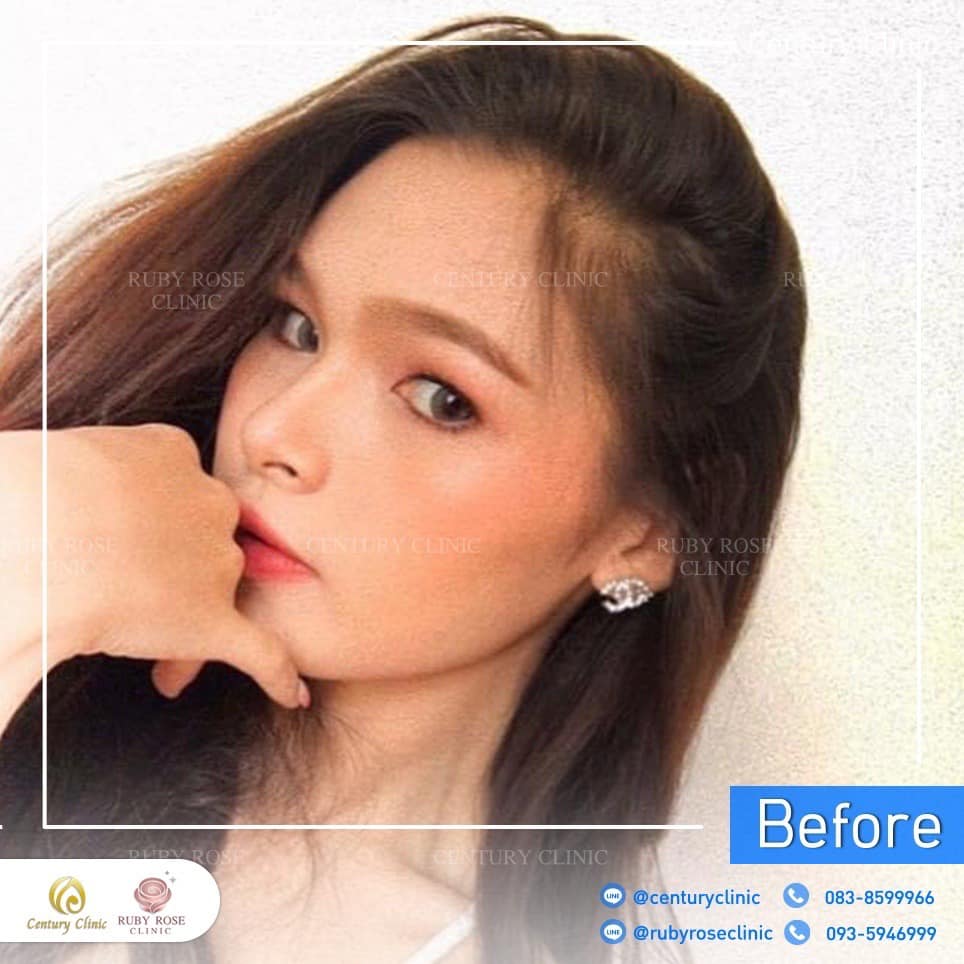 รีวิว เสริมจมูก #239 , Century Clinic Thailand Century รีวิว เสริมจมูก 2#238