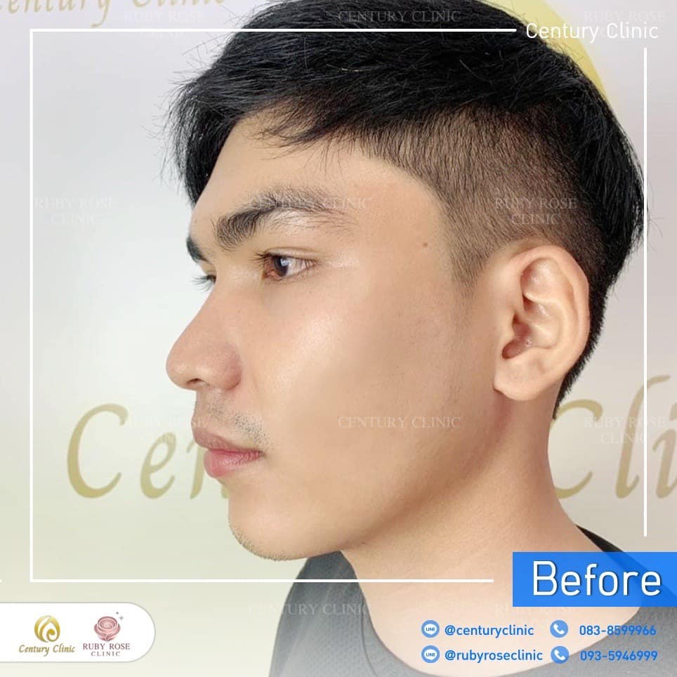 Century รีวิว เสริมจมูก 2#240