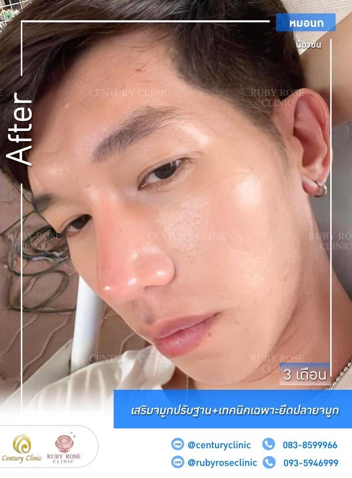 Century รีวิว เสริมจมูก #229