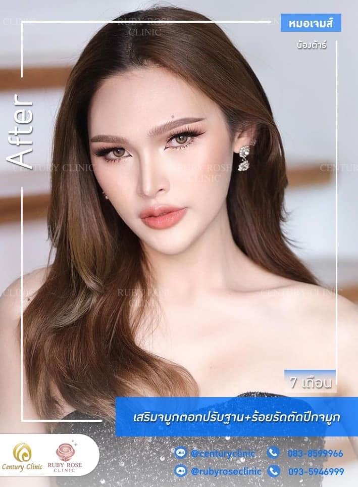 Century รีวิว เสริมจมูก #238