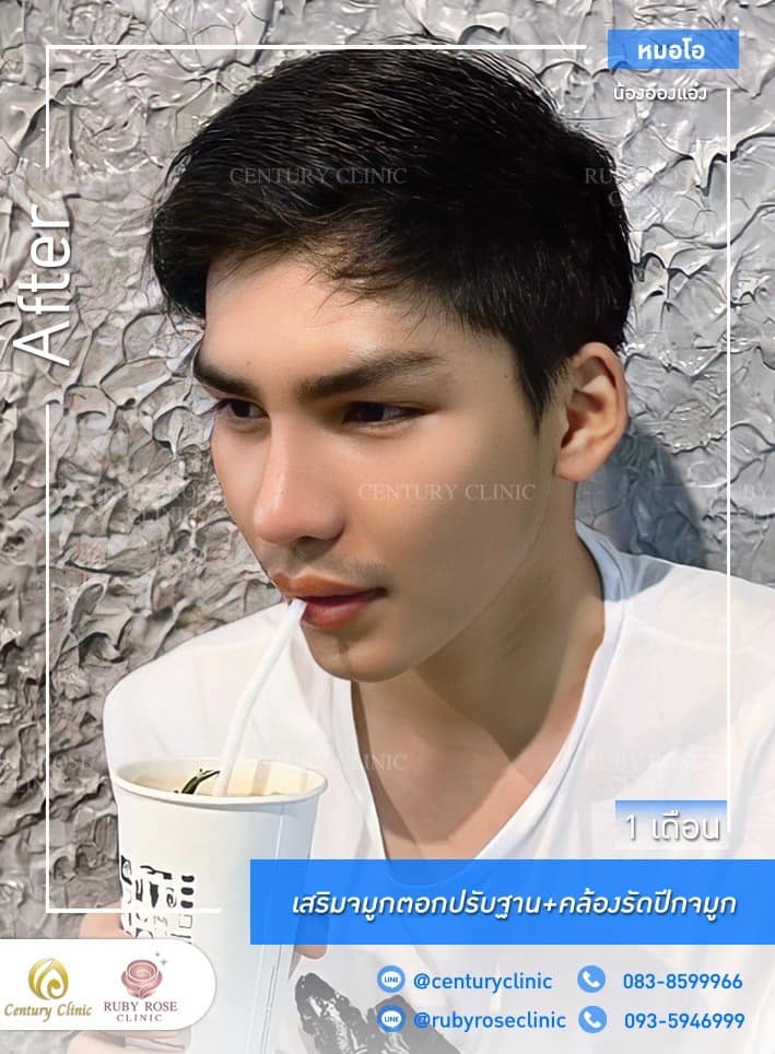 Century รีวิว เสริมจมูก #240