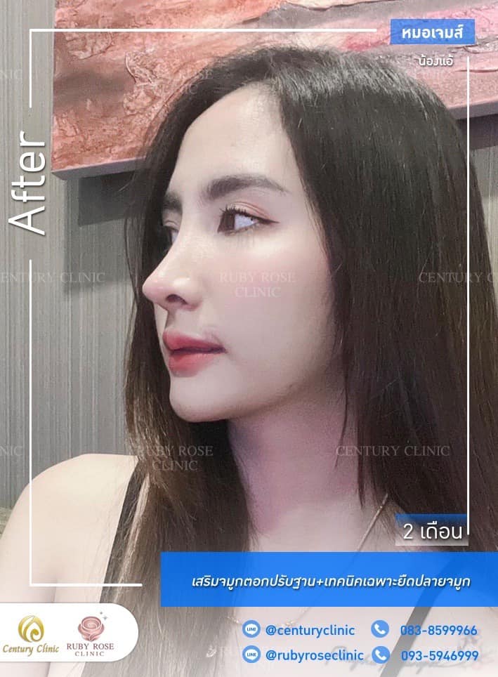 Century รีวิว เสริมจมูก #246