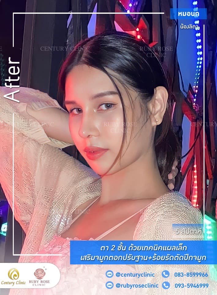 Century รีวิว เสริมจมูก #256