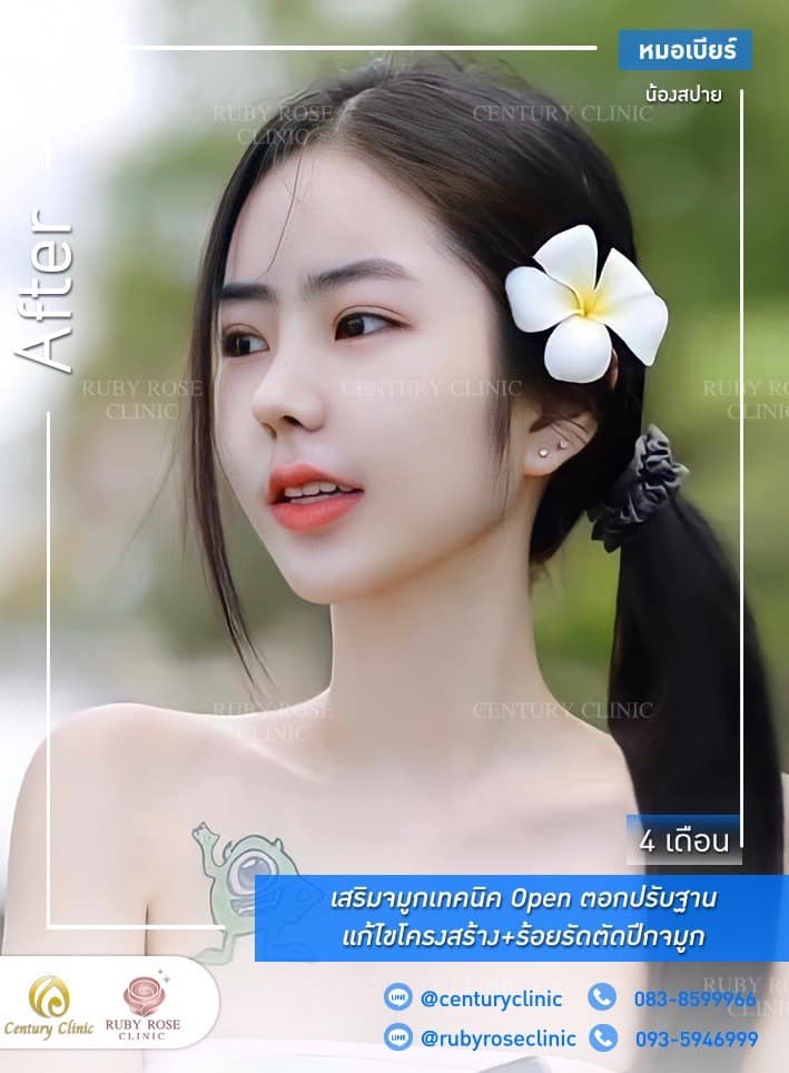 Century รีวิว เสริมจมูก #257