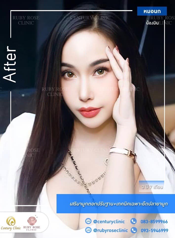Century รีวิว เสริมจมูก #258