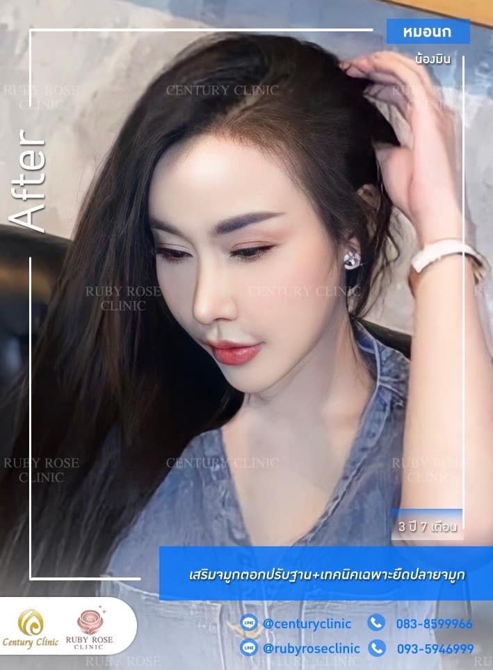 Century รีวิว เสริมจมูก #267