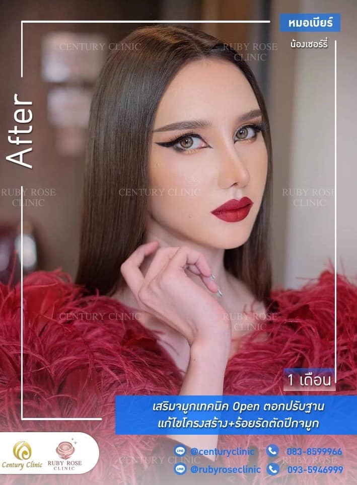 Century รีวิว เสริมจมูก #270