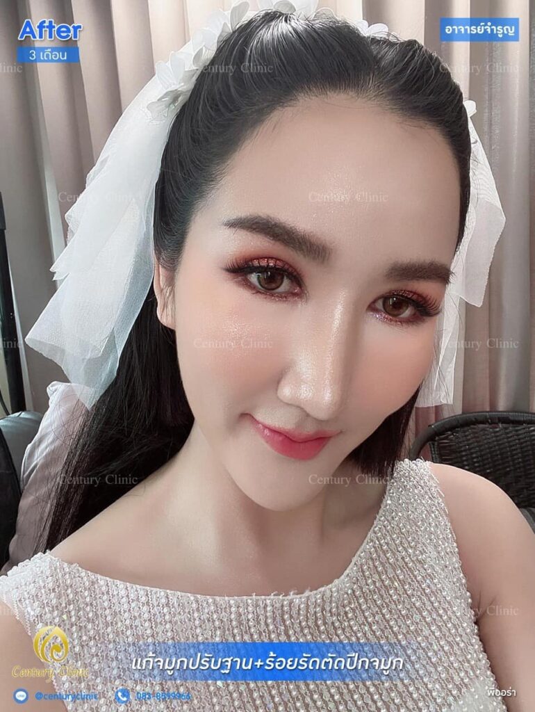 รีวิว แก้จมูก #172 , Century Clinic Thailand Century รีวิว แก้จมูก 1 #172