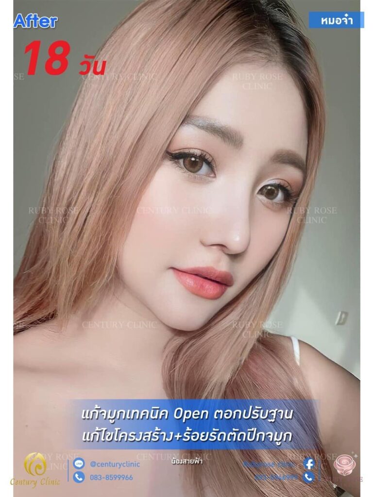 Century รีวิว แก้จมูก 1#155