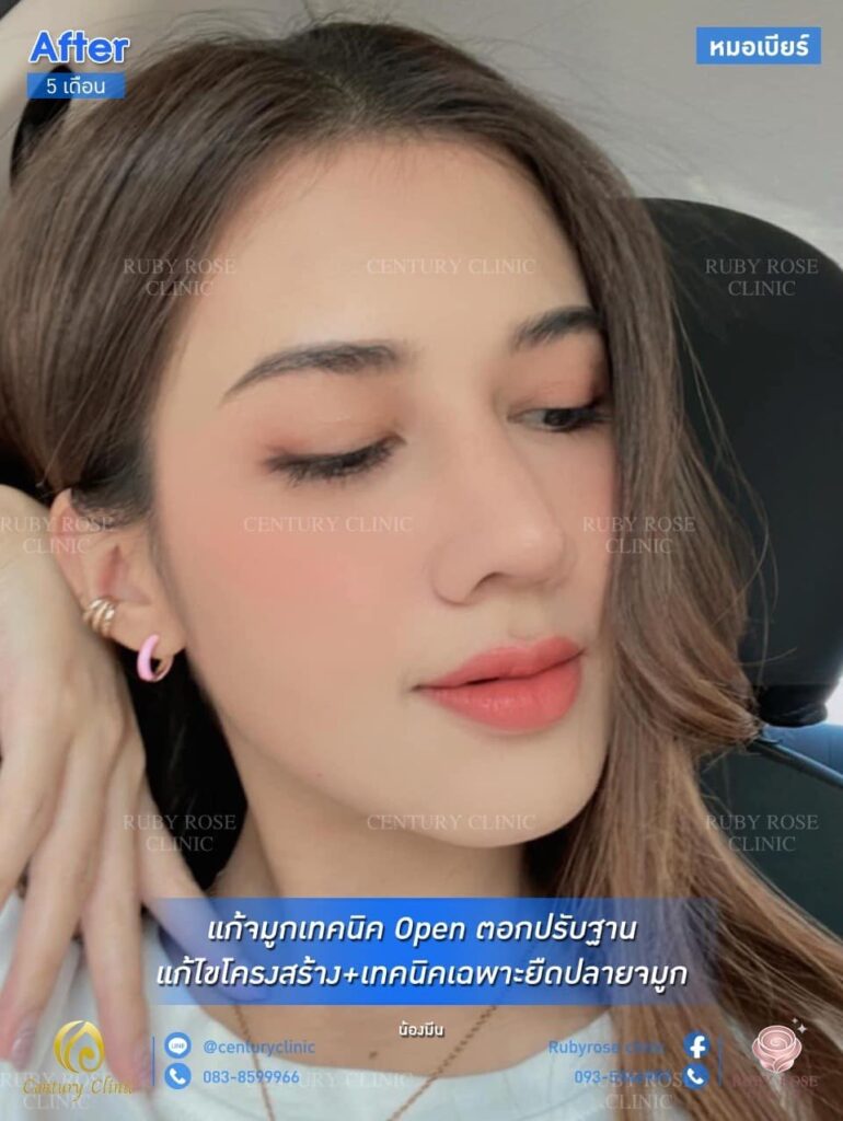 Century รีวิว แก้จมูก 1#160