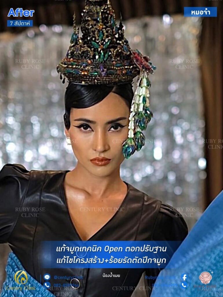 รีวิว แก้จมูก #167 , Century Clinic Thailand Century รีวิว แก้จมูก 1#167
